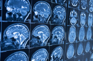 Why Choose Bello Law Firm, PLLC for Help After a Brain Injury in Raleigh, NC?